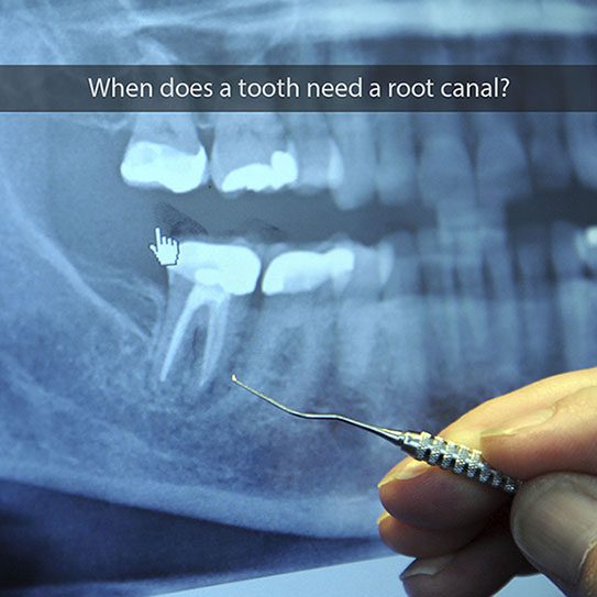 tooth that needs root canal