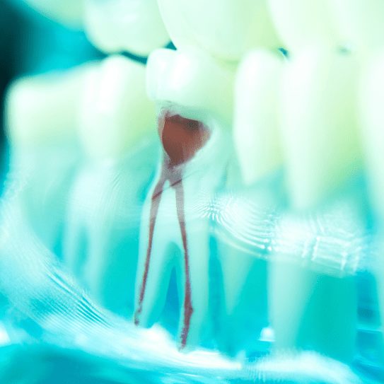 root canal in colorado city