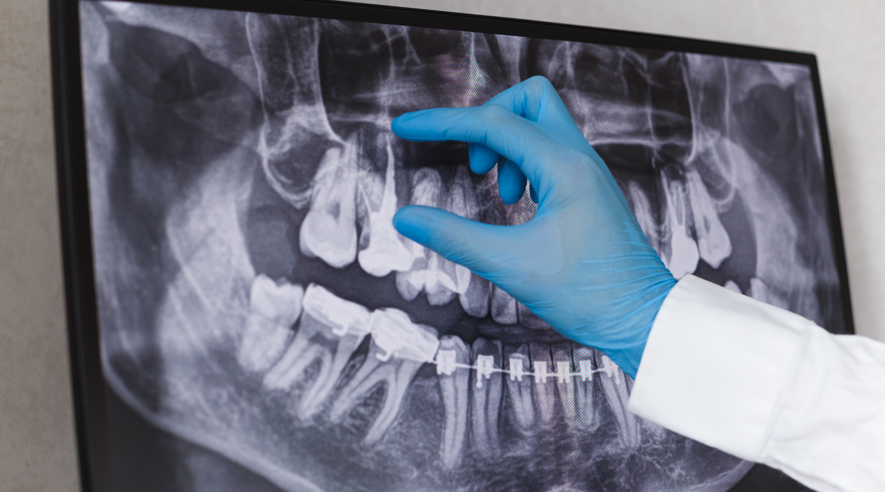root canal retreatment in colorado springs
